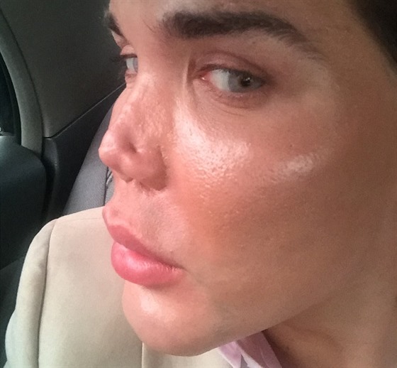 Rodrigo Alves ml komplikace po plastické operaci nosu. Tká mu poírala...