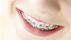 Rovnátka vyřeší estetický i zdravotní problém zubů.