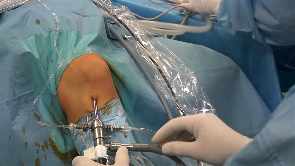 artróza kolene operace