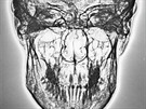 Na rentgenogramu lebky Karla IV. v pedozadní projekci je dobe patrný atypický...