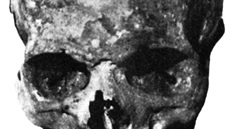 Lebka Karla IV na snímku z roku 1977 nese stopy rzných váných poranní z...
