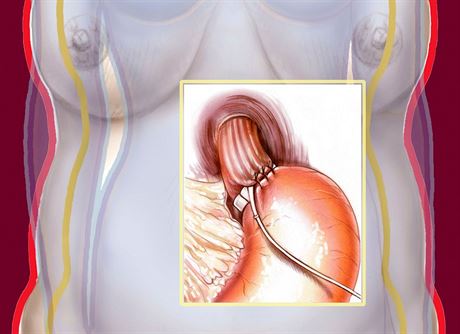 Bariatrická operace aludku pomáhá lidem s tkou obezitou (ilustraní...