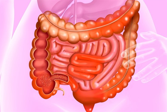 Crohnova choroba (ilustrační fotografie)