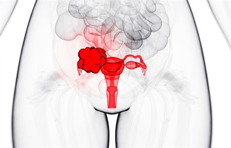 Rakovina vajeník je nebezpená v tom, e ji dlouho nemusíte poznat.