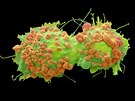 Nádorové buňky - rakovina vaječníků