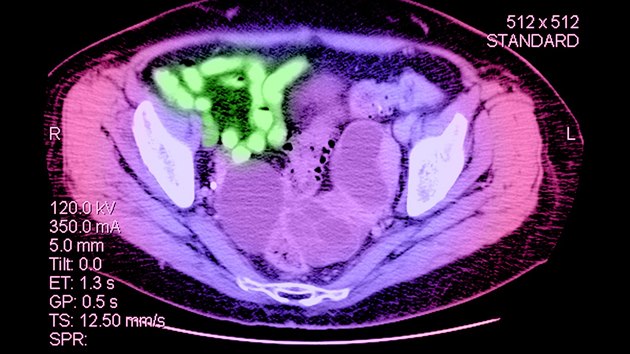 Snímek z CT, kde je zeleně označený nádor na vaječníku.