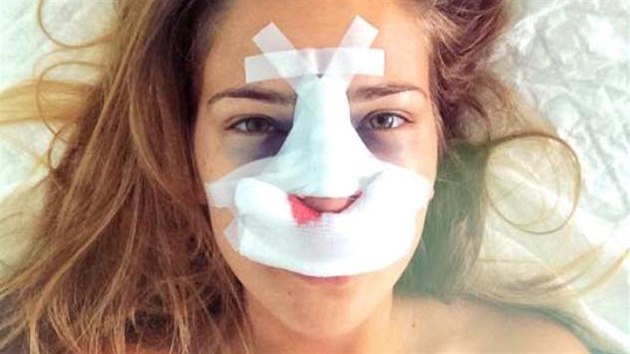 Andrea Bezděková po plastické operaci nosu
