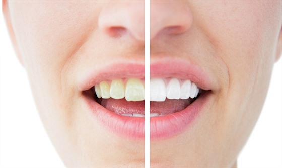 Bělení zubů nepřináší vždy stejný výsledek, může za to i genetika - iDNES.cz