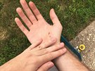 Mike Schultz ukazuje své zranní na ruce, který si pivodil, kdy na...