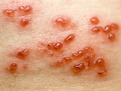 Bolestivé puchýky jsou pi pásovém oparu typickým píznakem.