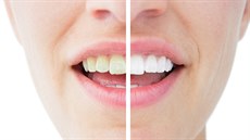 Bělení zubů před a po (ilustrační fotografie)