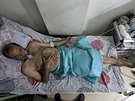 Nemocnicím v syrském Aleppu chybí podle lékařů zdravotnický materiál a lidé jim...