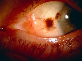 Kromě kůže známe i melanom oka, velmi vzácně se může vyskytnout i na sliznicích.