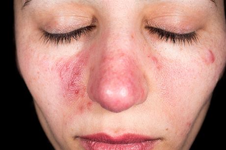 Rovka (rosacea)