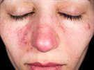 Rovka (rosacea)