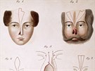 Rekonstrukce nosu na ilustraci z roku 1815