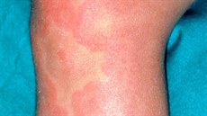 Vyrážka, která vzniká při chladové alergii