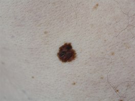 Až 50 procent melanomů vznikne na podkladě pigmentového znaménka. Na snímku je...