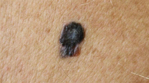 Tmav barva znamnka je jeden z varovnch signl. Na snmku je vidt melanom s ern pigmentovanm loiskem nepravidelnho tvaru a s lesklmi vbky.