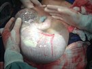 Dít narozené v neporuených plodových obalech, jak jej zachytil ecký porodník