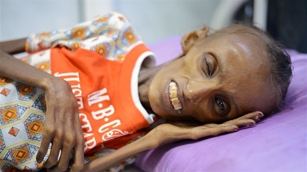 Osmnctilet Jemenka trp extrmn podvivou. (25. jna 2016)