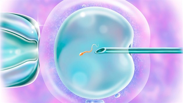 Počít dítě přirozeně bývá stále těžší. Jen v Česku je neplodností postiženo zhruba 15 procent dvojic. Dobrou zprávou je, že až 90 procent z nich se nakonec vytouženého miminka dočká. K tomu jim pomáhá i metoda IVF neboli oplodnění mimo tělo. Jak pokračuje vznik nového života po vpravení spermie do vajíčka, se můžete podívat v galerii.