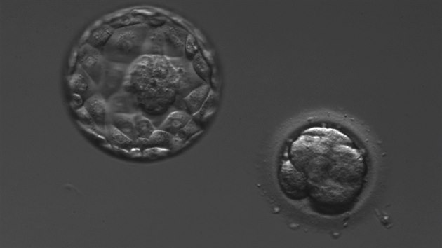 Pt den vvoje. Zde je jasn vidt postupujc embryo ve stadiu blastocysty (optimln stav pro den 5), druh embryo je definitivn zastaveno ve vvoji (to men na obrzku) a ji vvoj nikdy nedoene. Ve velk me se zastav embrya geneticky vadn, je to vlastn prodn vbr, kter neovlivnme, vysvtluje embryoloka Jelnkov.