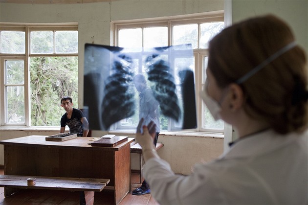 Počet lidí s tuberkulózou vzrostl, nejvíc přibývá mezi uprchlíky z Ukrajiny