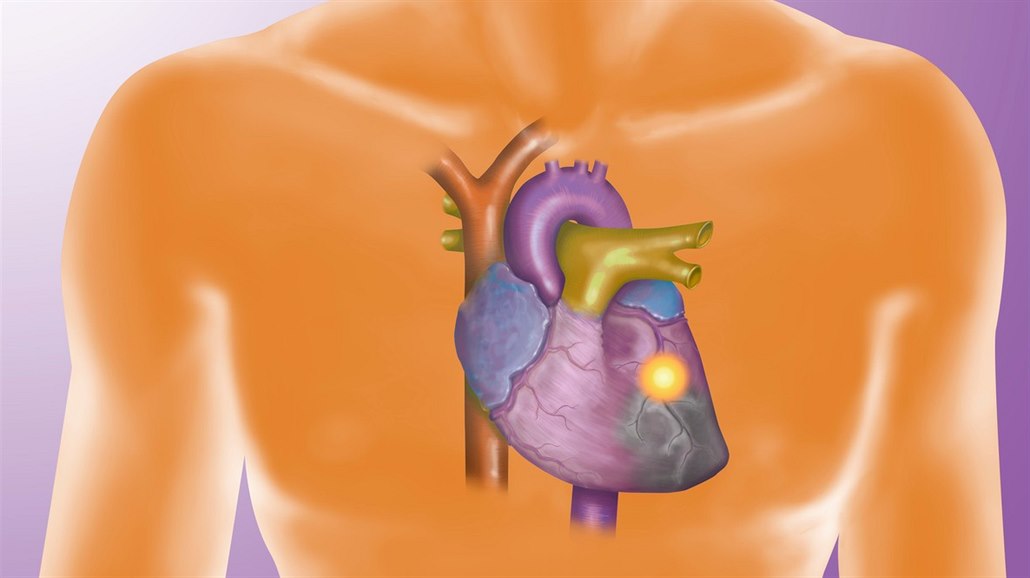 Co se děje při infarktu?