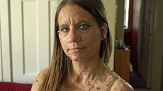 Libby Hufferová se snaží získat peníze na další operaci, která by jí od nádorů...