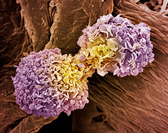 Buňky rakoviny prsu (ilustrační snímek)