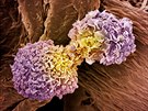 Buky rakoviny prsu (ilustraní snímek)