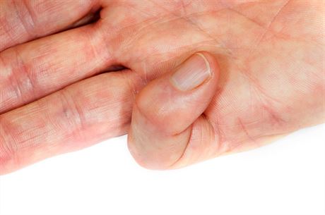 Sevení prstu a úplné omezení hybnosti je jedním z píznak nemoci.