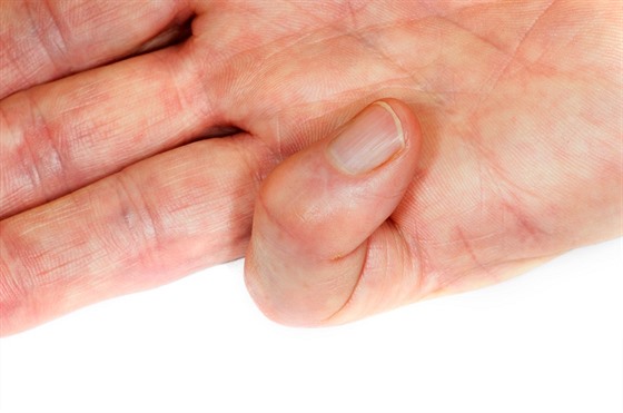 Sevření prstu a úplné omezení hybnosti je jedním z příznaků nemoci.