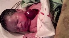 Novorozen se narodilo se srdcem mimo tlo