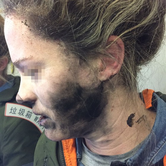 Snímek obličeje cestující, které na hlavě vzplála sluchátka.