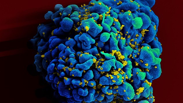 Virem HIV nakažená buňka imunitního systému