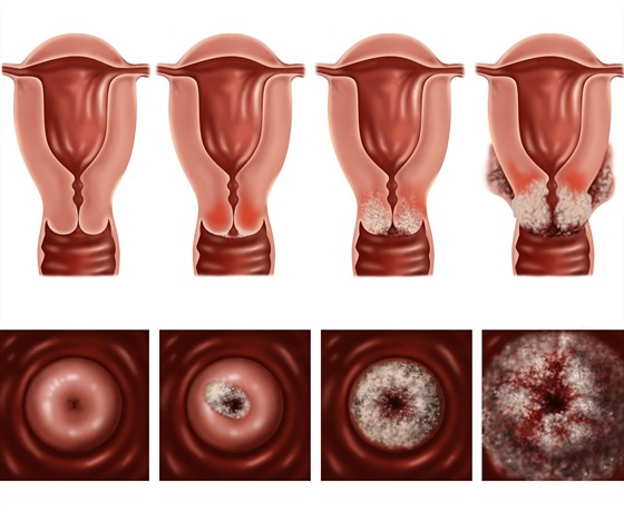 hpv infekce ockovani contra negilor