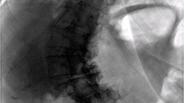 Zakřivená páteř na rentgenovém snímku před operací.