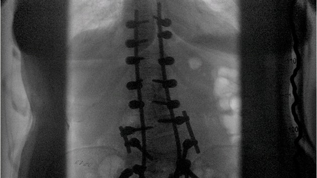 Páteř na rentgenovém snímku po operaci.