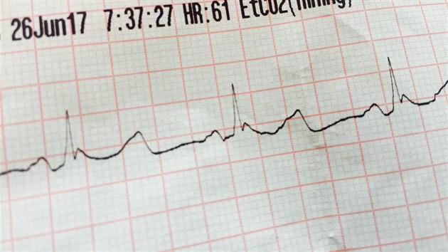 Mezi specifické příznaky závažné hypotermie patří přítomnost tzv. Osbornovy vlny na EKG, která byla poprvé popsána v roce 1953 (26.6.2017).