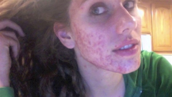 Modelka Cassandra Banksonová svj boj s akné sdílí s 800 tisíci fanouk na...