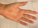 Tento snímek zobrazuje nynjí stav ruky Petry Kvitové..
