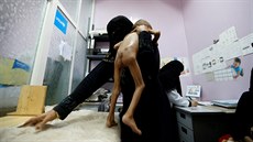 Na 3,3 milionu dtí v Jemenu trpí podvýivou.
