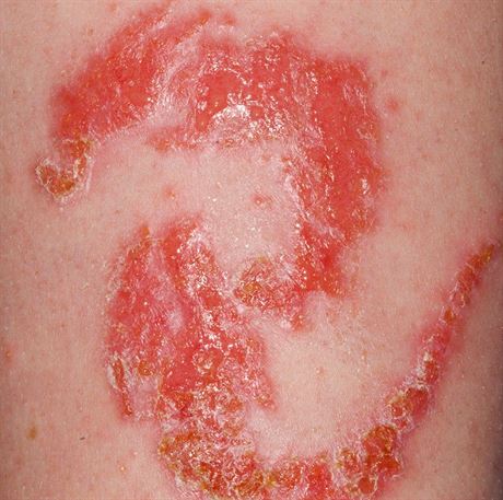 Alergick reakce na tetovn hennou.