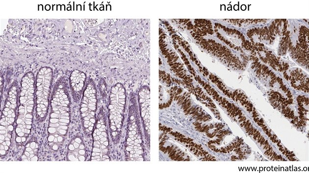 Protein p53 značený tentokrát hnědě (drobné oválky – buněčná jádra – v levé mikrofotografii) na histologickém řezu lidským střevem. Mutovaný protein se sice vyskytuje v nádorové tkáni ve vysoké koncentraci, ale jeho schopnost bránit zhoubnému bujení už byla ztracena. Obrázky nádorů s velkým množstvím p53 mátl vědce v 80. letech. Sváděl k mylnému závěru, že p53 je pro-nádorový protein. Až později vyšlo najevo, že se v tomto případě jedná o nefunkční, mutovaný protein.
