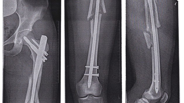 Zlomenina po tech tdnech od operace