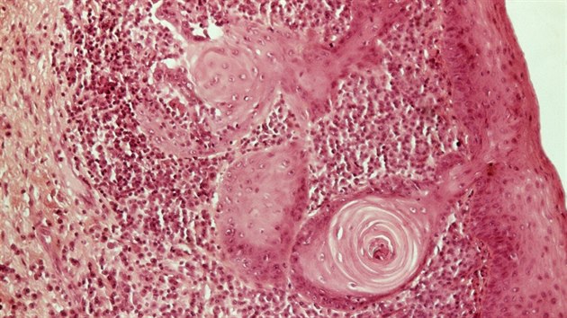 Mikrofotografie průřezu laryngeální tkáně zobrazující rakovinné buňky, které vytvořily malé laloky (kulaté).