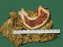 Vyoperovaný nádor aludku, který vzniká postupnou nádorovou pemnou bunk...