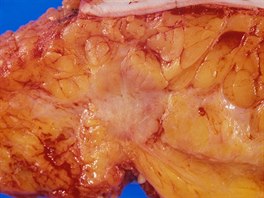 Odstraněná prsní tkáň se zhoubným nádorem (světlá část uprostřed). Rakovina...